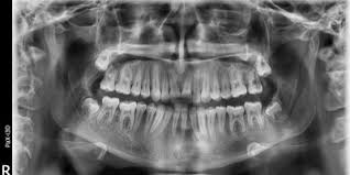 Panorex X-ray Film