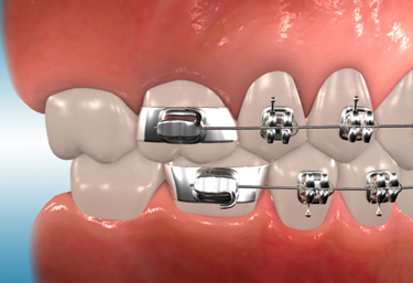 Orthodontic Bands on Typodont