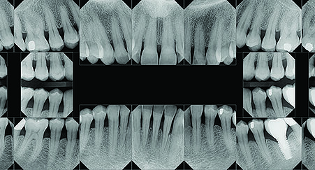 FMX Dental X-rays