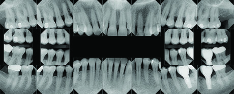 FMX Dental X-rays