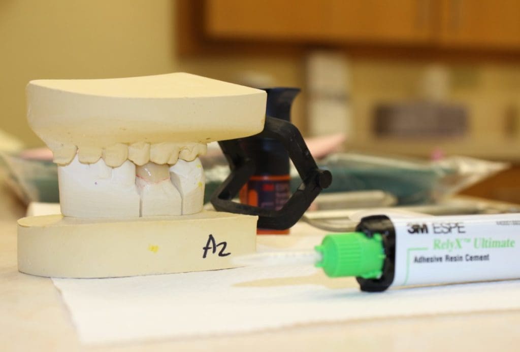Fabricating of Provisional Crowns and Bridges